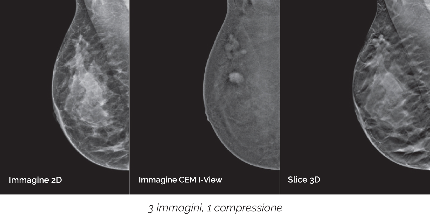 Individuazione di lesioni spesso non visibili con le mammografie standard